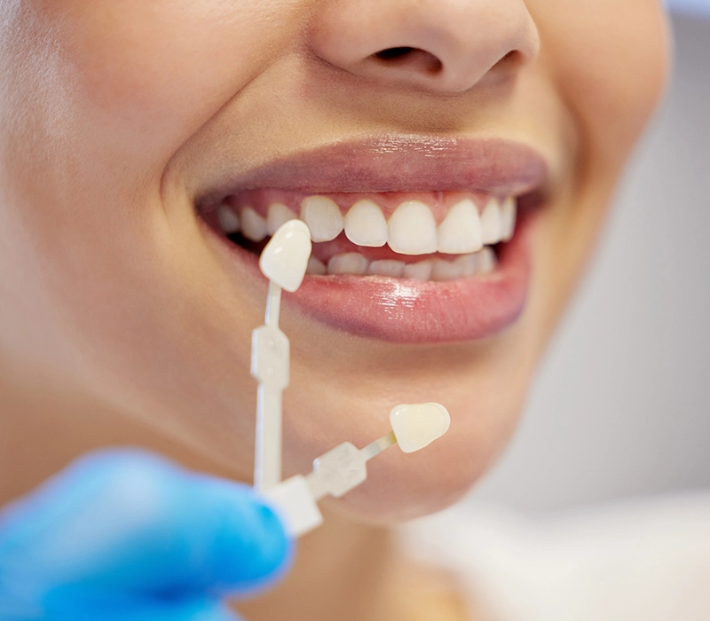 Muestras de tonos dentales para realizar odontología restauradora.