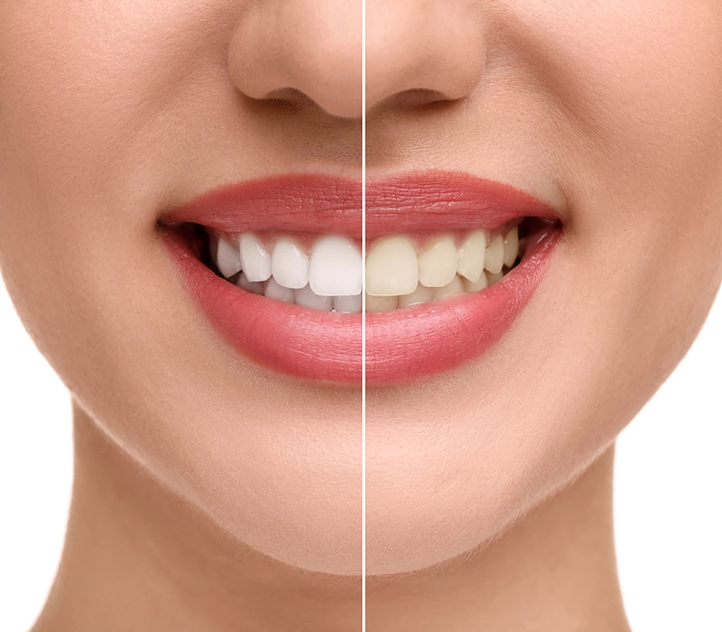 Antes y después de blanqueamiento dental.