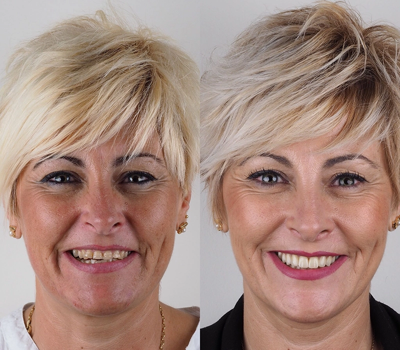 Antes y después de un tratamiento de estética dental.