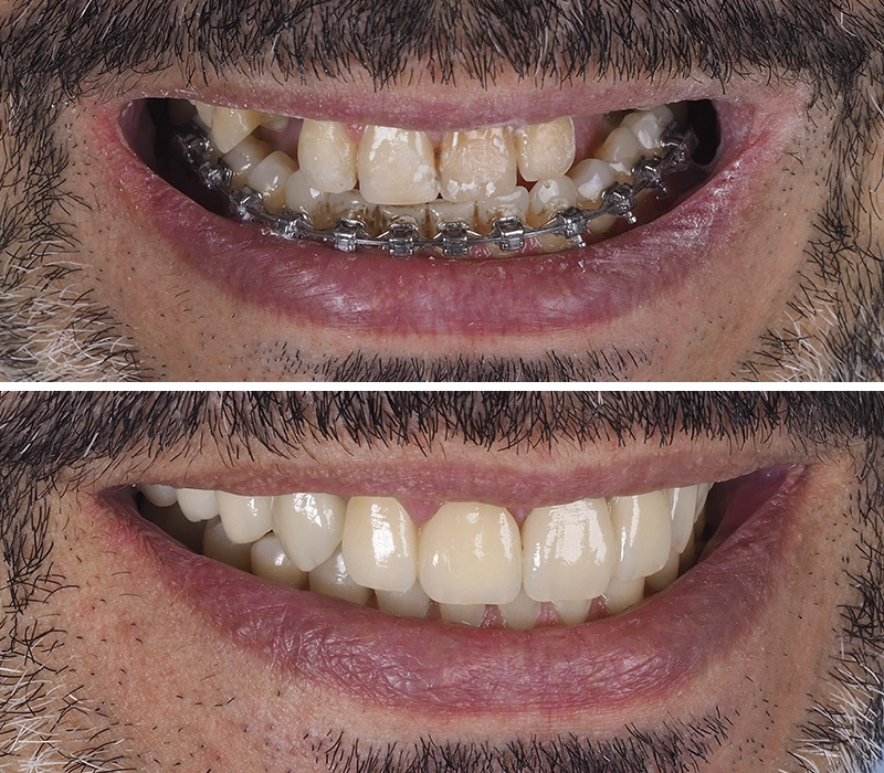 Antes y después de un tratamiento de prótesis dental.