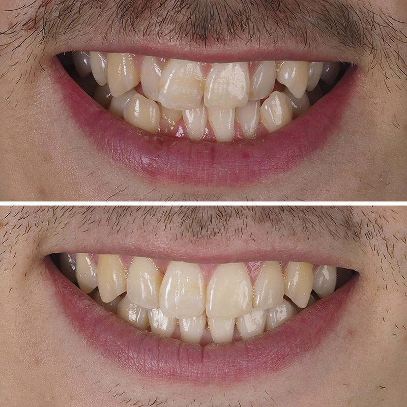 Antes y después de ortodoncia dental.