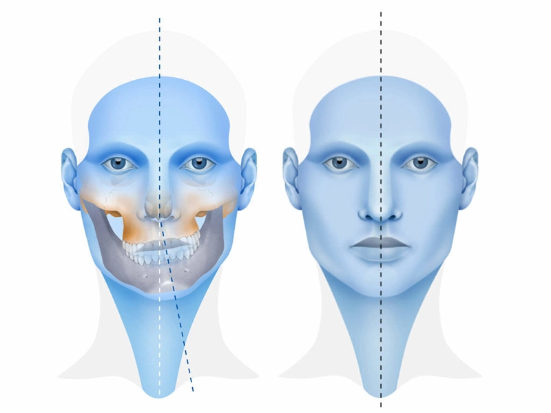 Ilustración donde se la asimetría facial.