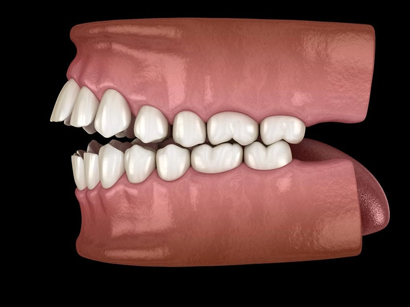 Render de una mordida que hace referencia a la asimetría facial.