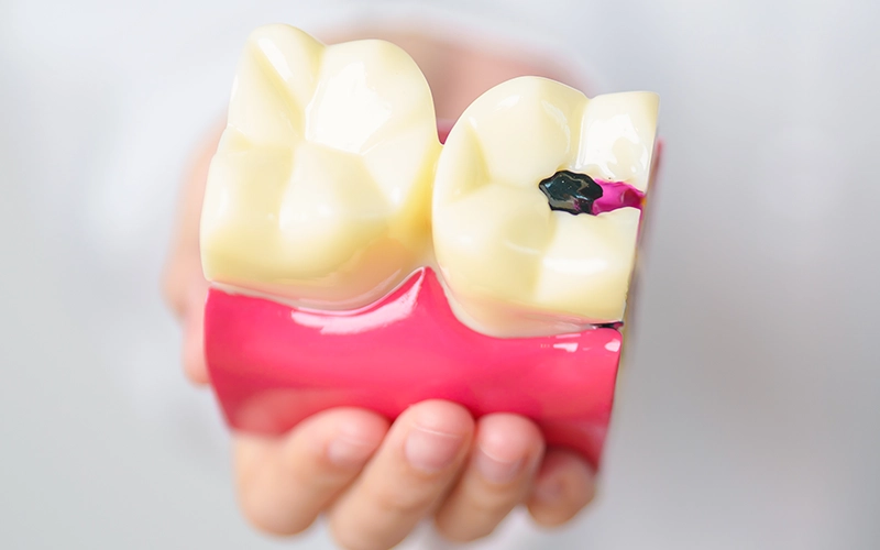 Molde de unas muelas con caries.