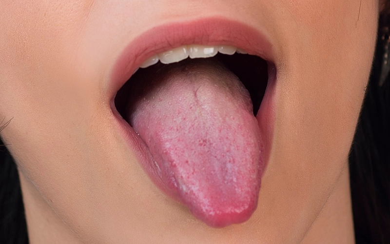 Síntomas de celiaquía en la lengua.