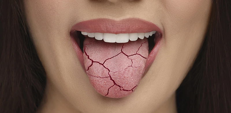 Lengua con sequedad.