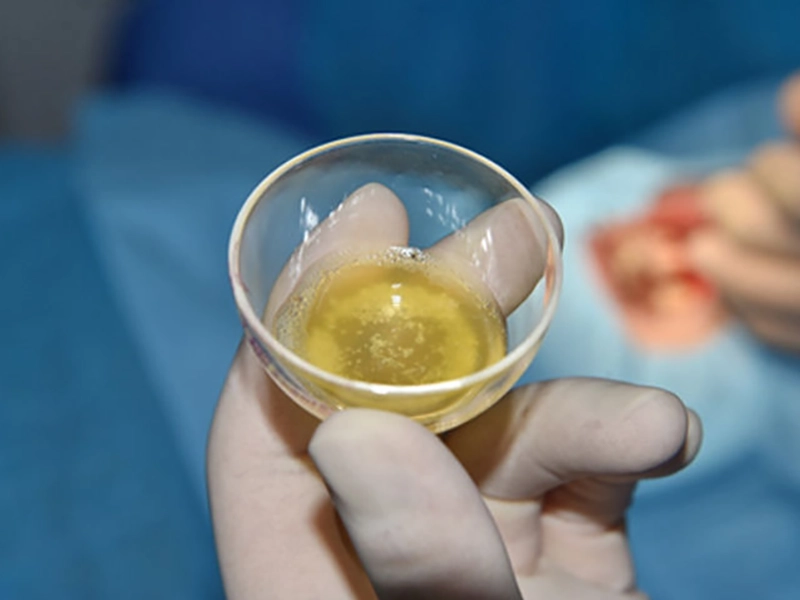 Primer plano de Plasma rico en factores de crecimiento.