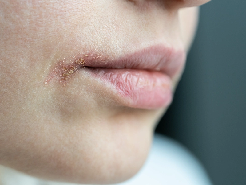 Primer plano de Queilitis.