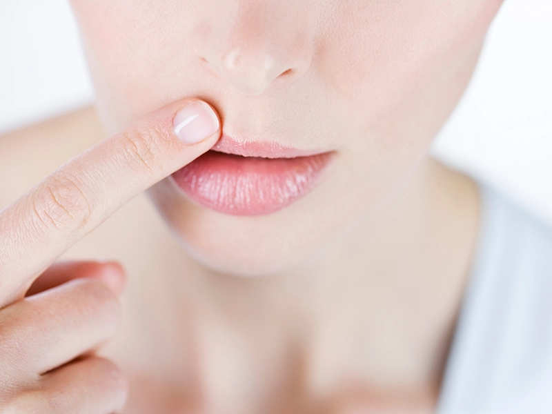 Boca que sufre alergia a material dental.