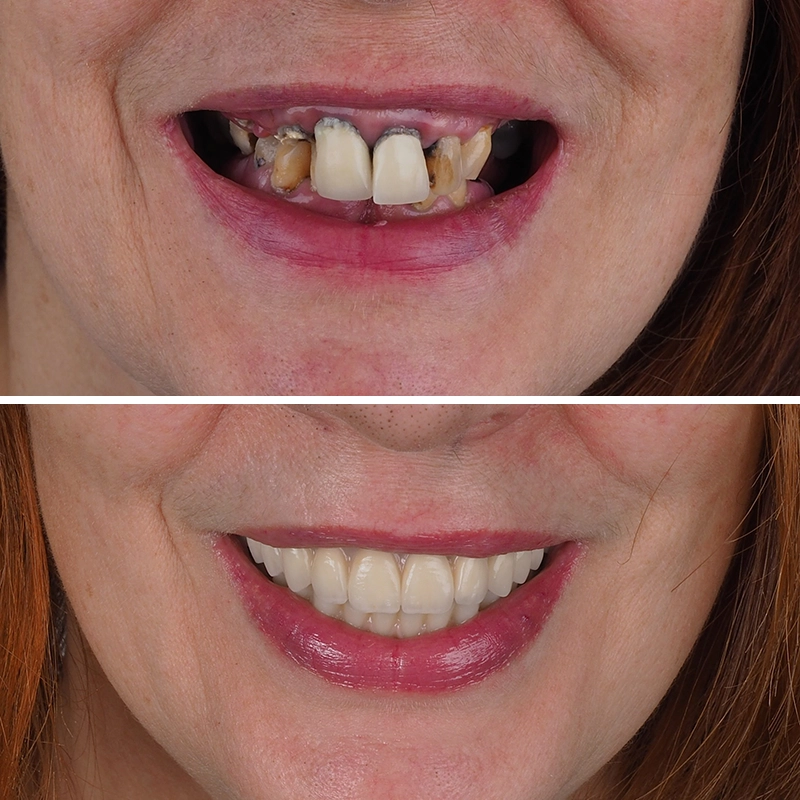 Antes y después de tratamiento de implantología oral.