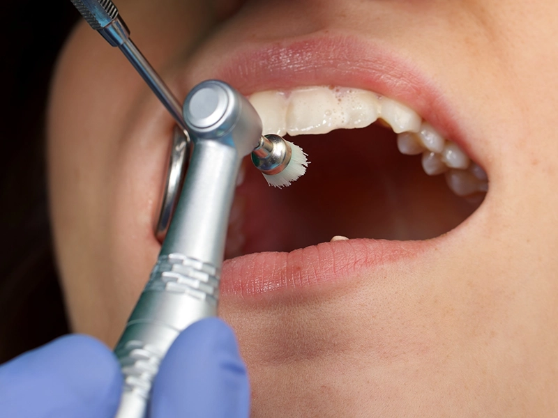 Tratamiento de profilaxis dental.