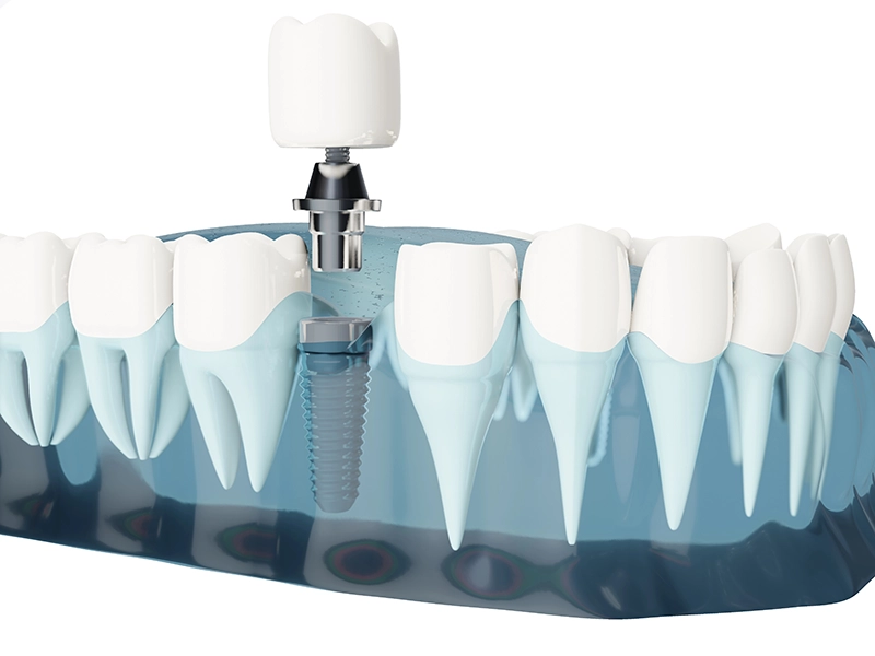 Render de un implante dental.